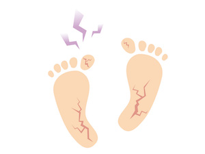 足底筋膜炎　足の痛み