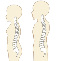 背骨の弯曲　ストレートネック　首の痛み